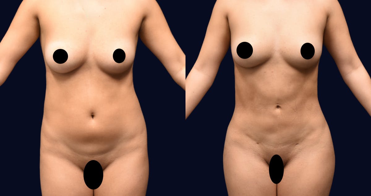 Brazilian Butt Lift Before & After Gallery - Patient 601994 - Image 2