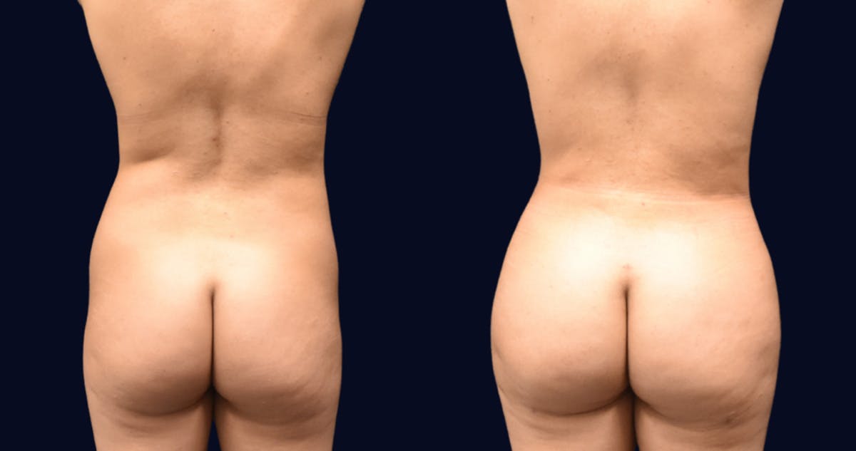 Brazilian Butt Lift Before & After Gallery - Patient 601994 - Image 1