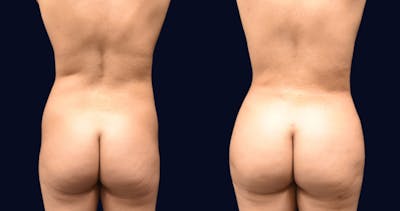 Abdominoplasty with Liposuction Before & After Gallery - Patient 118399 - Image 1