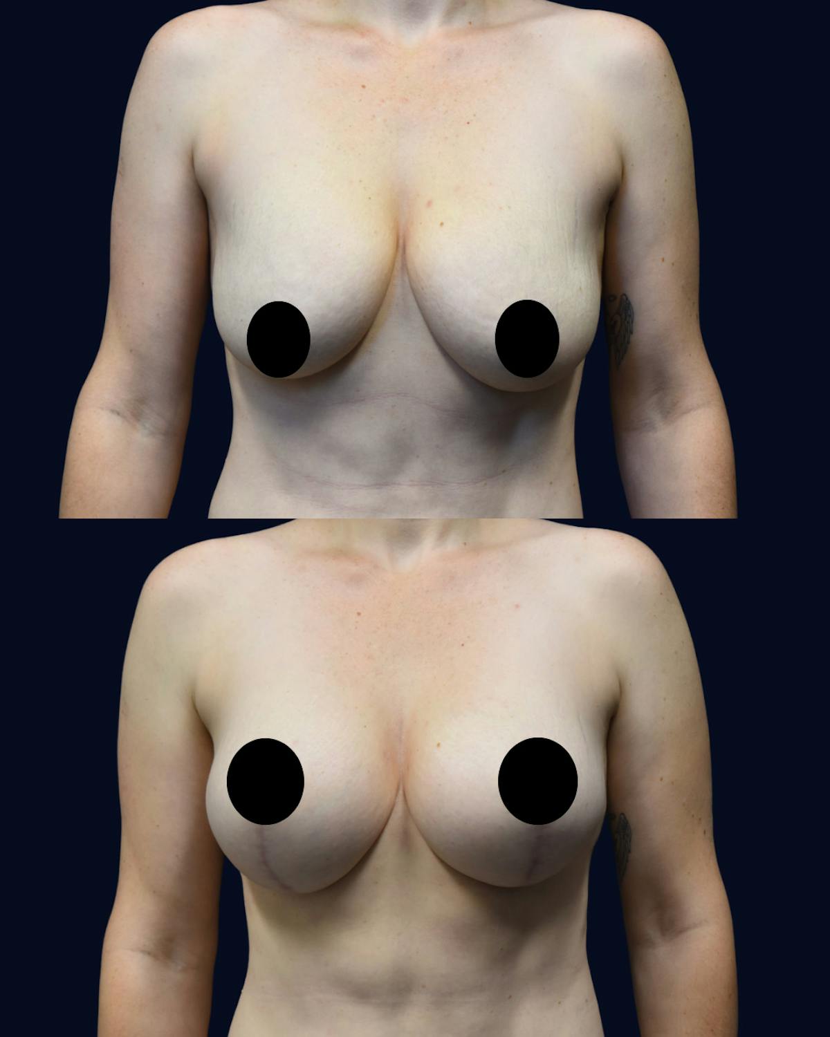 Breast Lift Before & After Gallery - Patient 350559 - Image 1