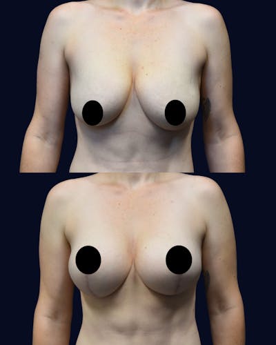 Breast Lift Before & After Gallery - Patient 350559 - Image 1