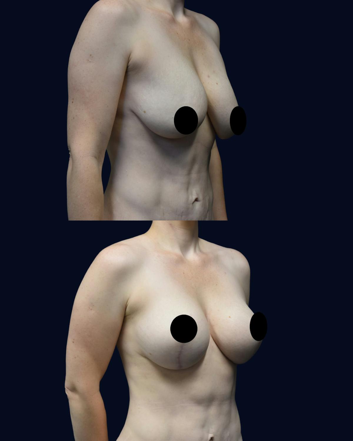 Breast Lift Before & After Gallery - Patient 350559 - Image 2