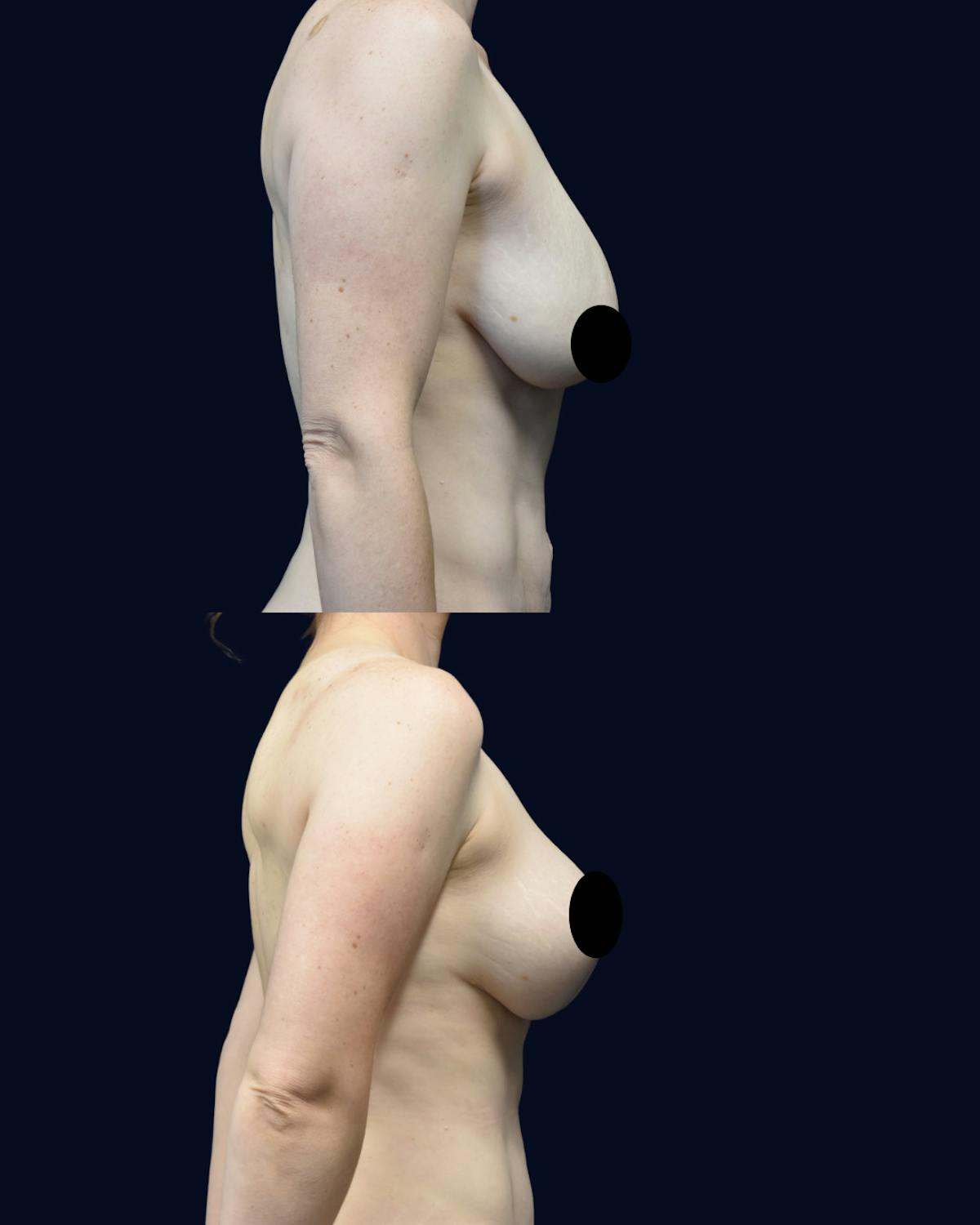 Breast Lift Before & After Gallery - Patient 350559 - Image 3