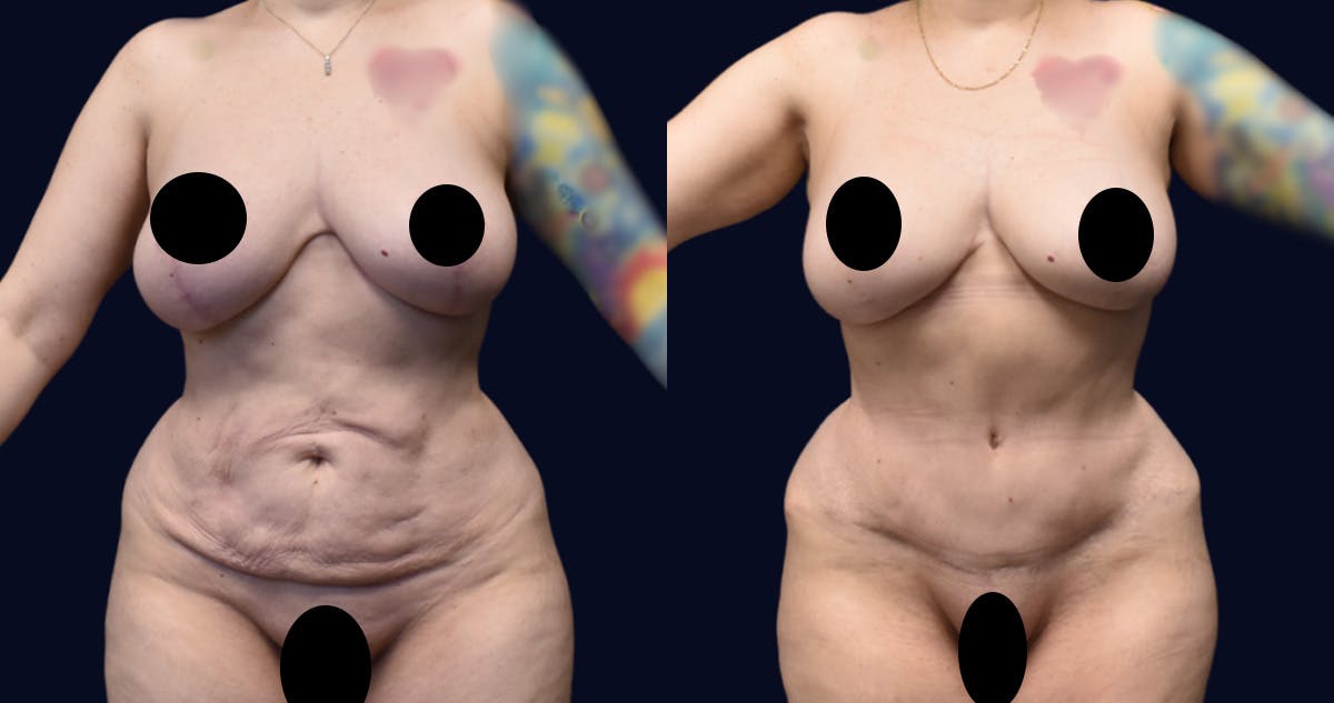 Abdominoplasty (Tummy Tuck) Before & After Gallery - Patient 198816 - Image 1
