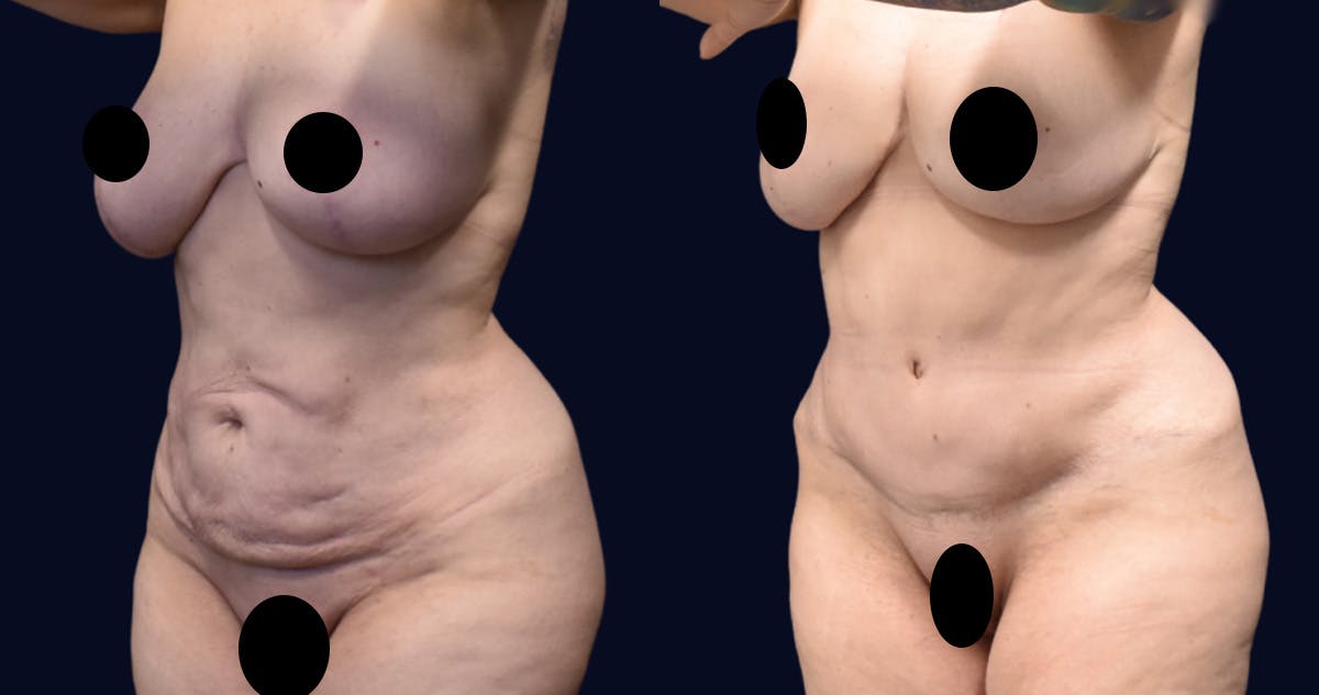 Abdominoplasty (Tummy Tuck) Before & After Gallery - Patient 198816 - Image 2