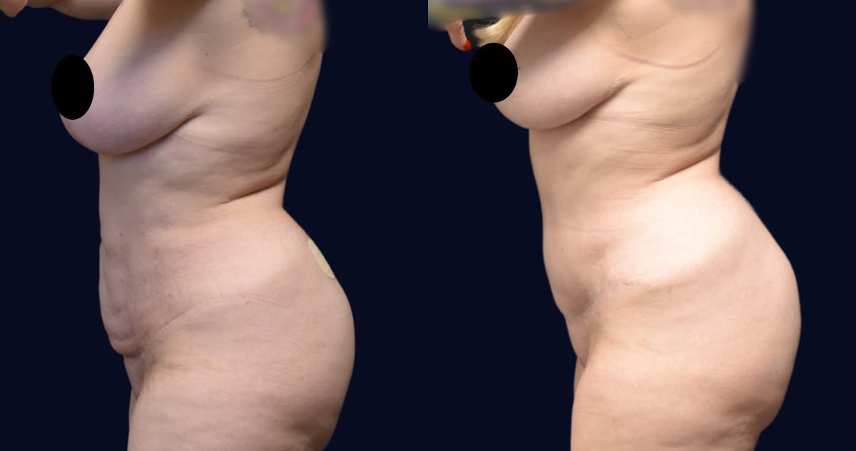Abdominoplasty (Tummy Tuck) Before & After Gallery - Patient 198816 - Image 3