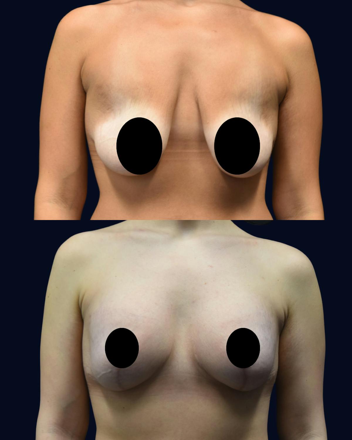 Breast Lift Before & After Gallery - Patient 197240 - Image 1