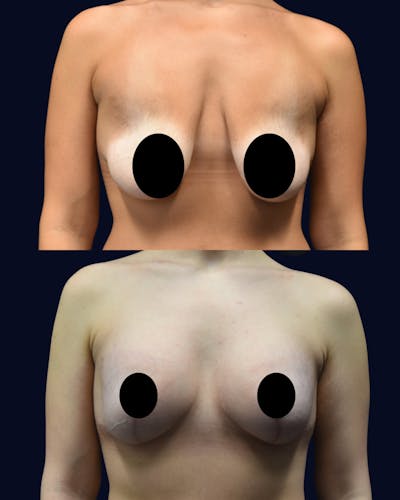 Breast Lift with Implants Before & After Gallery - Patient 395238 - Image 1