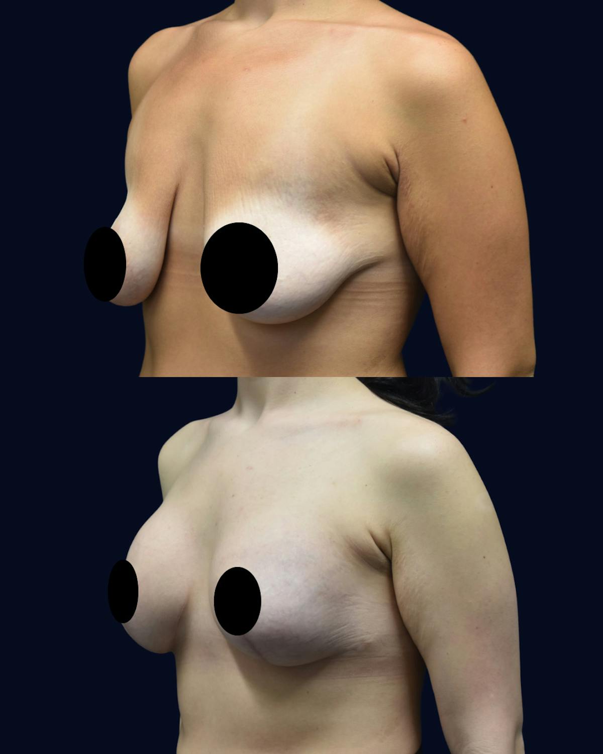 Breast Lift Before & After Gallery - Patient 197240 - Image 2