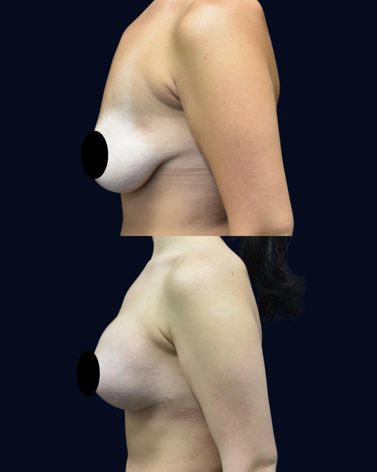 Breast Lift Before & After Gallery - Patient 197240 - Image 3