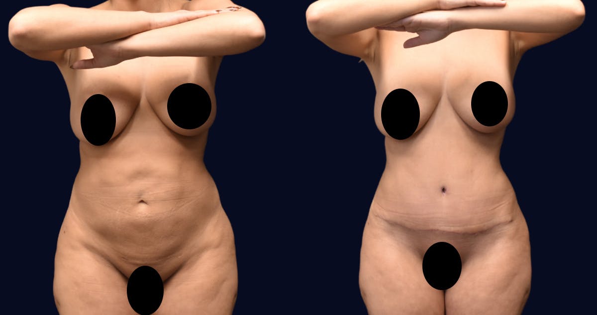 Abdominoplasty (Tummy Tuck) Before & After Gallery - Patient 215963 - Image 2