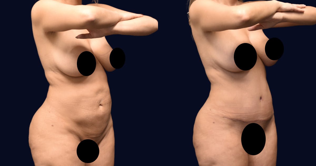 Abdominoplasty (Tummy Tuck) Before & After Gallery - Patient 215963 - Image 3