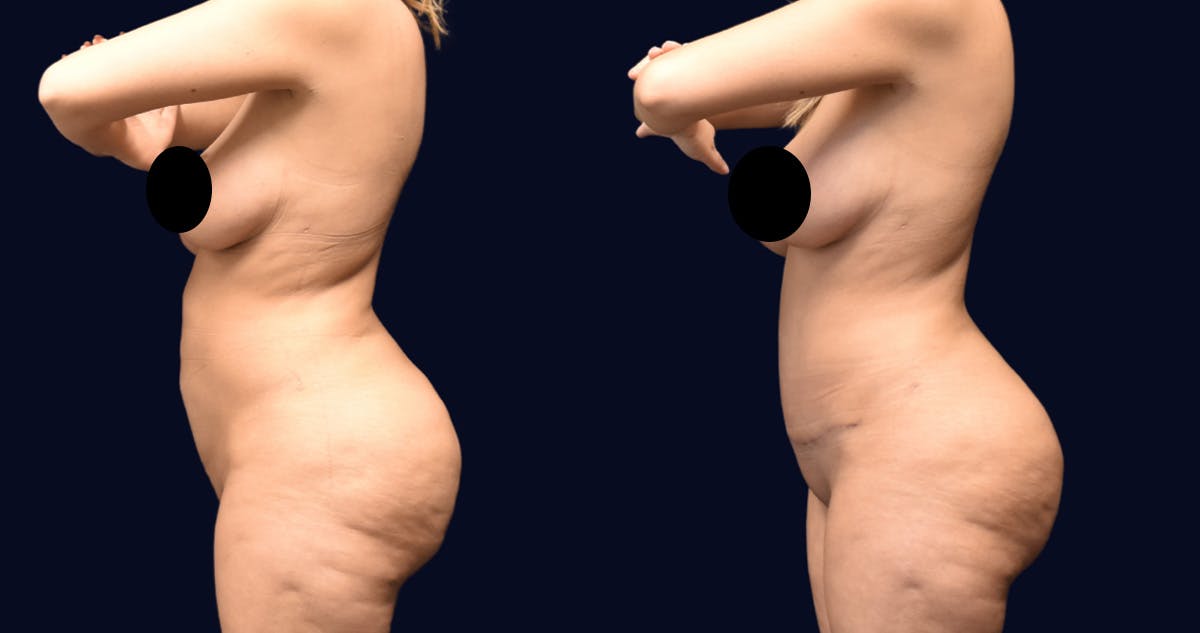 Abdominoplasty (Tummy Tuck) Before & After Gallery - Patient 215963 - Image 4