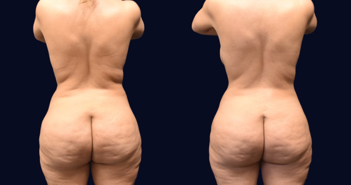 Abdominoplasty (Tummy Tuck) Before & After Gallery - Patient 215963 - Image 5