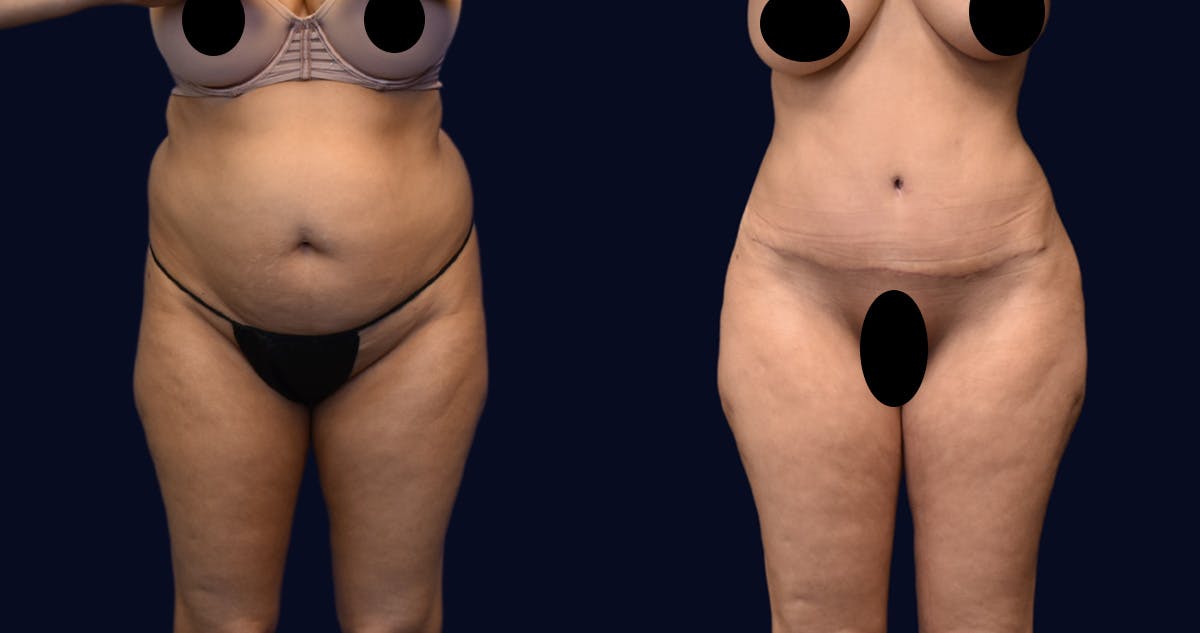 Abdominoplasty (Tummy Tuck) Before & After Gallery - Patient 215963 - Image 1