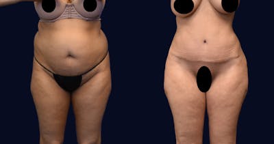 Abdominoplasty (Tummy Tuck) Before & After Gallery - Patient 215963 - Image 1