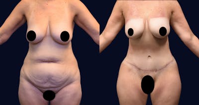 Abdominoplasty (Tummy Tuck) Before & After Gallery - Patient 270784 - Image 1