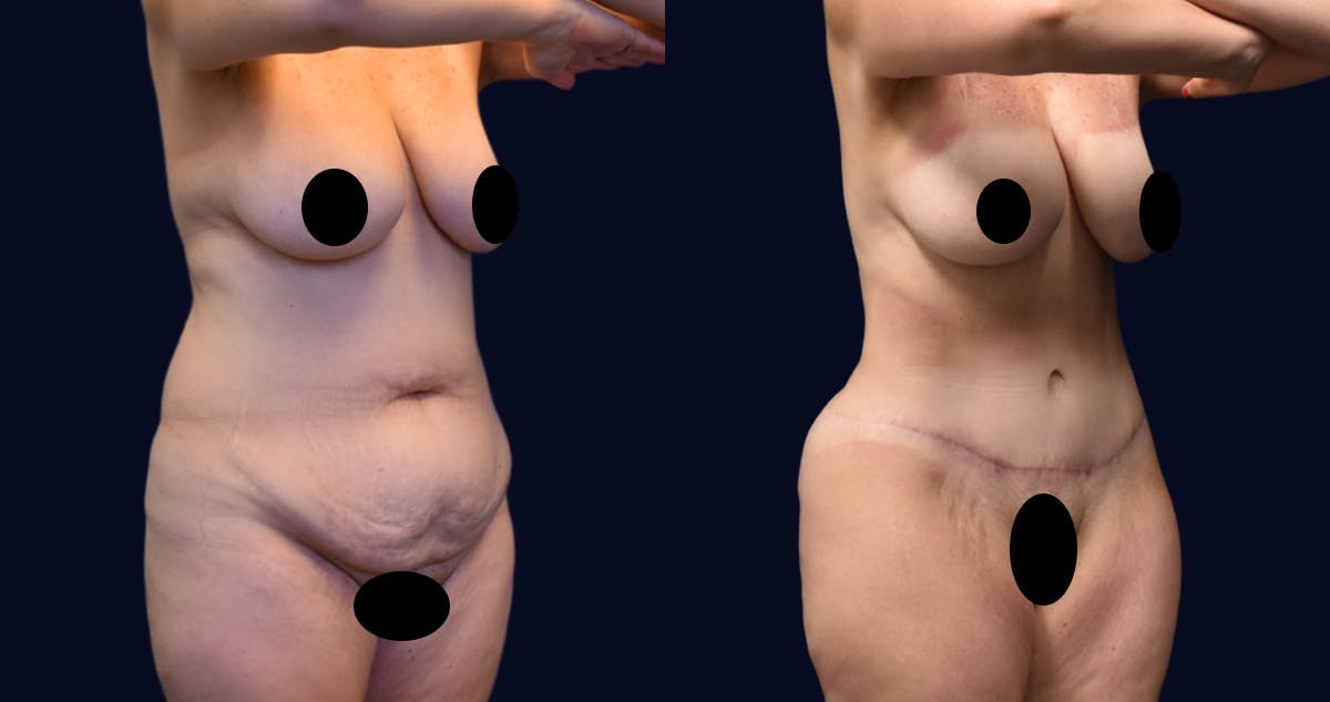 Abdominoplasty (Tummy Tuck) Before & After Gallery - Patient 270784 - Image 2