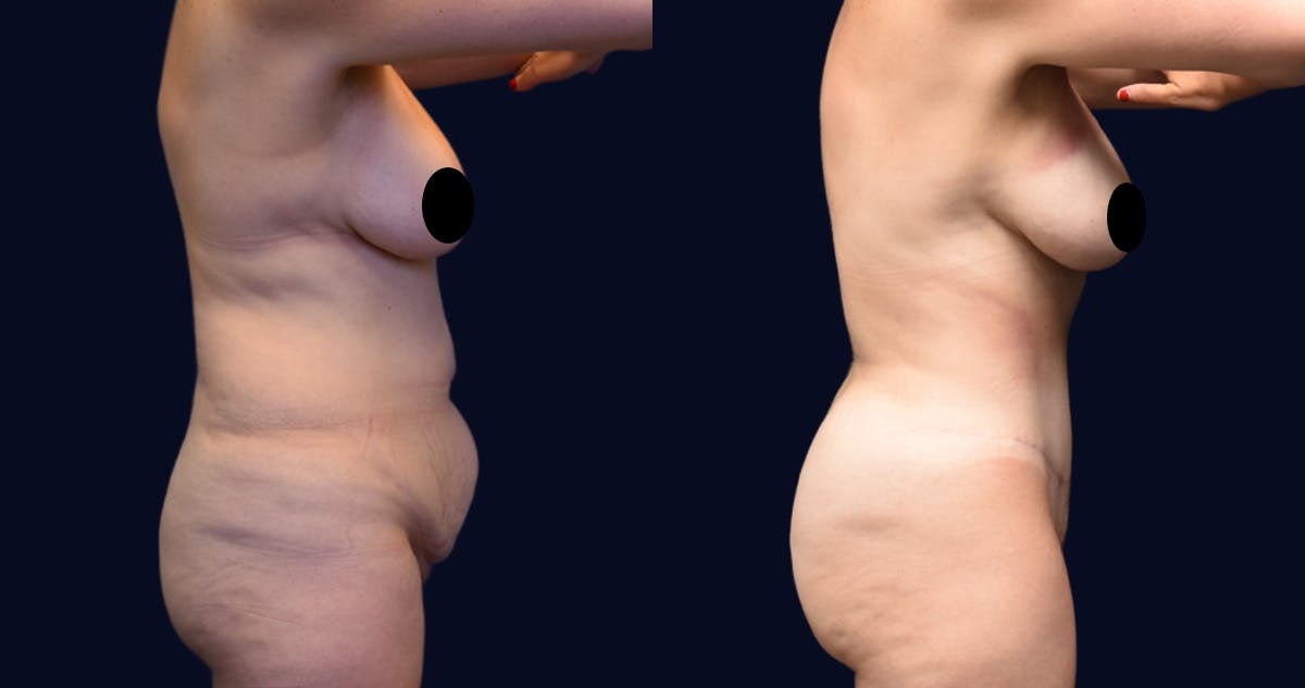Abdominoplasty (Tummy Tuck) Before & After Gallery - Patient 270784 - Image 3