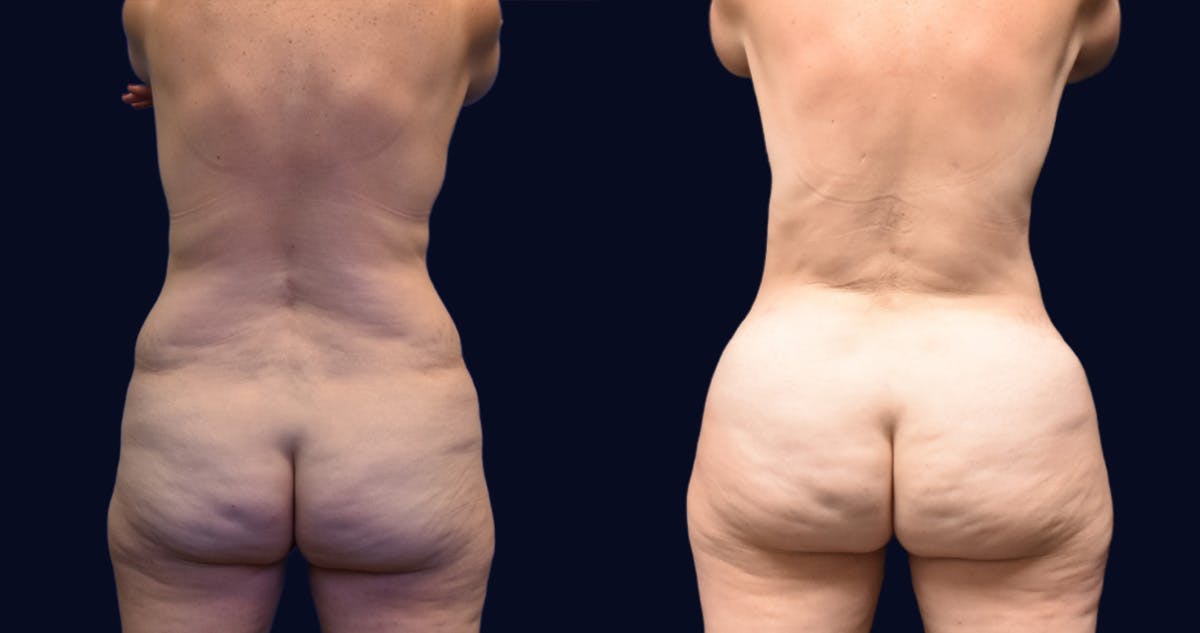 Abdominoplasty (Tummy Tuck) Before & After Gallery - Patient 270784 - Image 4