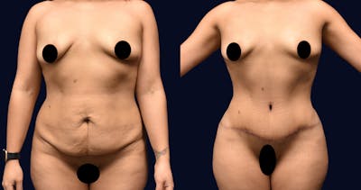 Abdominoplasty (Tummy Tuck) Before & After Gallery - Patient 173040 - Image 1