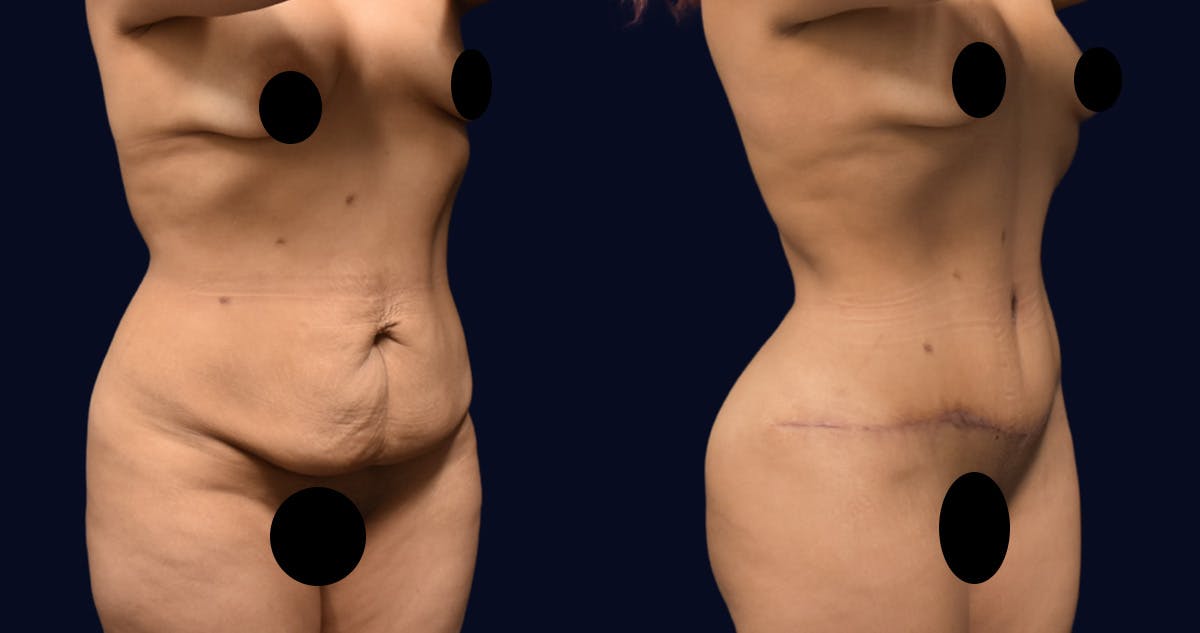 Brazilian Butt Lift Before & After Gallery - Patient 997852 - Image 3
