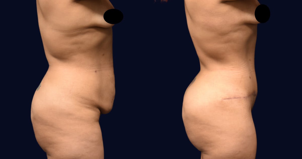 Brazilian Butt Lift Before & After Gallery - Patient 997852 - Image 4