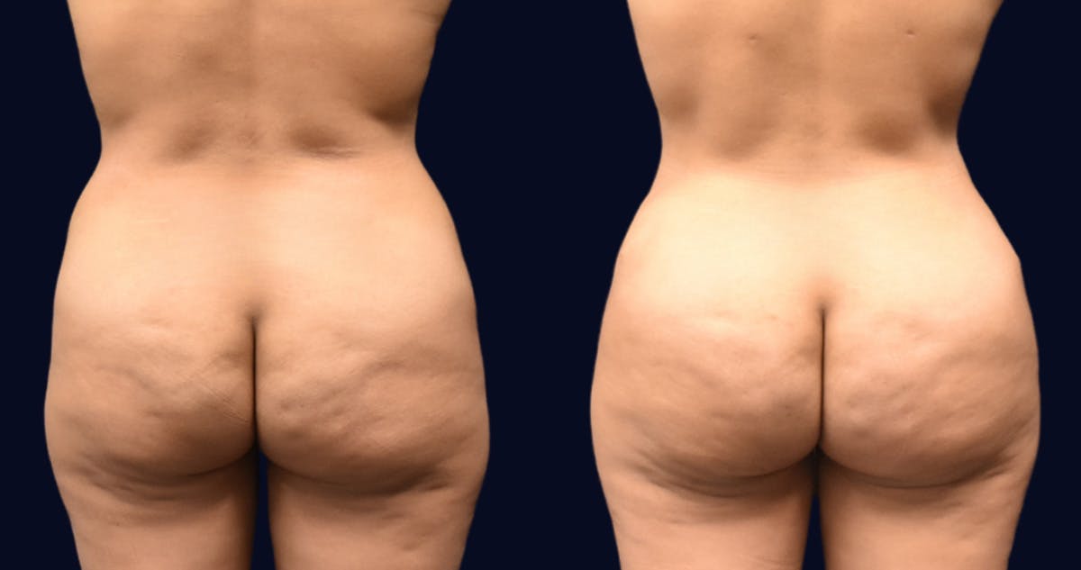 Brazilian Butt Lift Before & After Gallery - Patient 997852 - Image 1