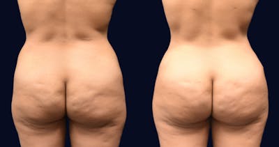 Brazilian Butt Lift Before & After Gallery - Patient 997852 - Image 1