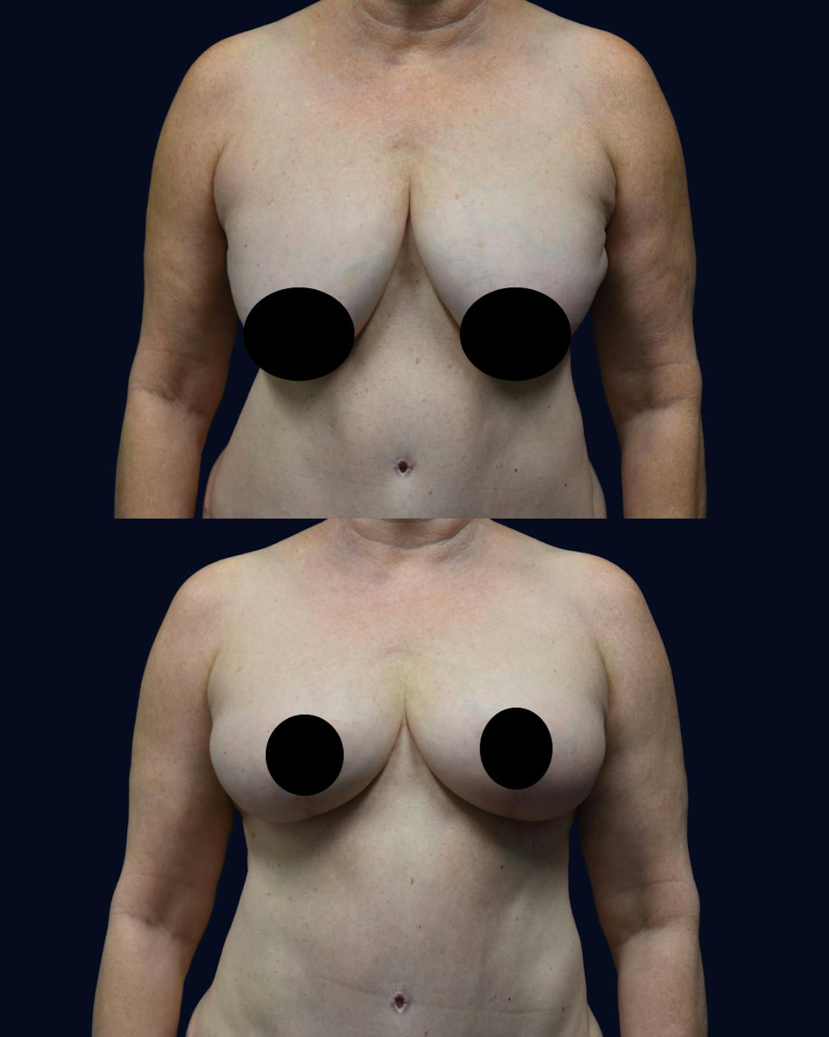 Breast Reduction and Lift Before & After Gallery - Patient 110578 - Image 1