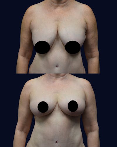 Breast Reduction and Lift Before & After Gallery - Patient 110578 - Image 1