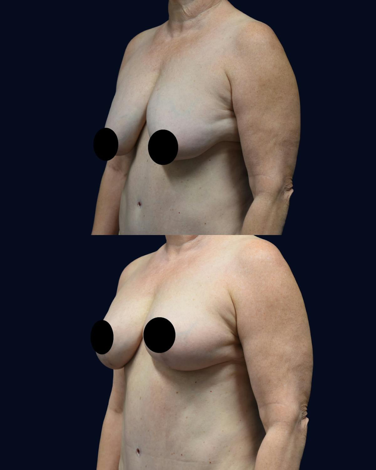 Breast Reduction and Lift Before & After Gallery - Patient 110578 - Image 2