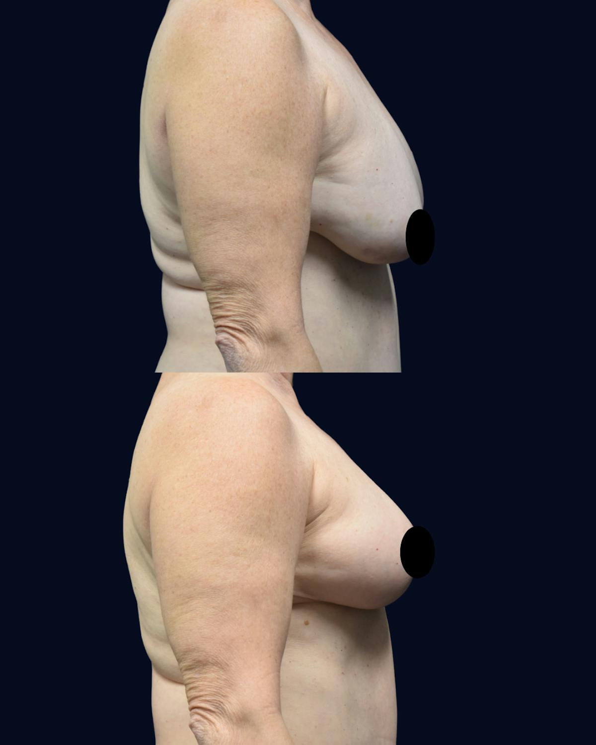 Breast Reduction and Lift Before & After Gallery - Patient 110578 - Image 3