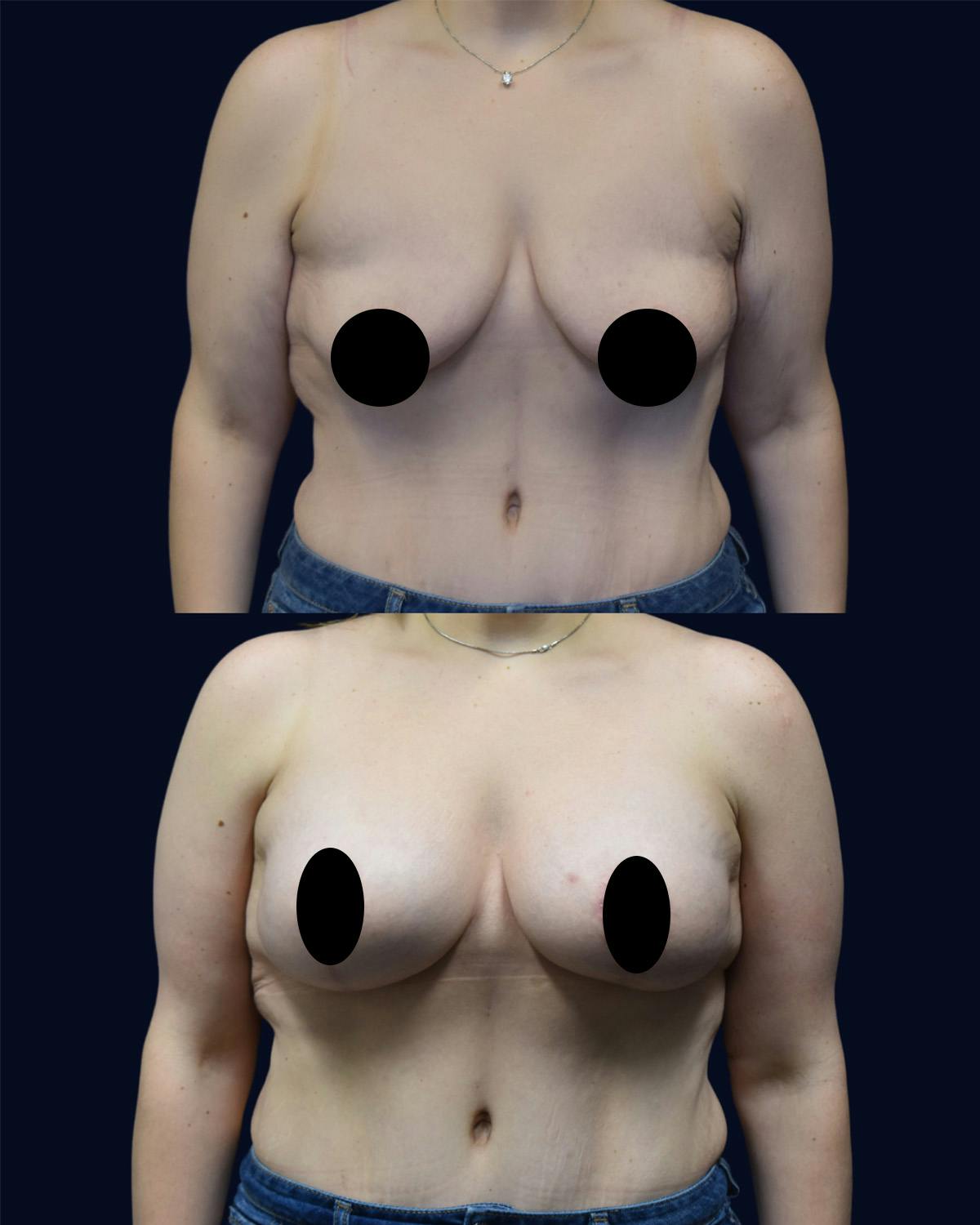 Breast Lift Before & After Gallery - Patient 310954 - Image 1
