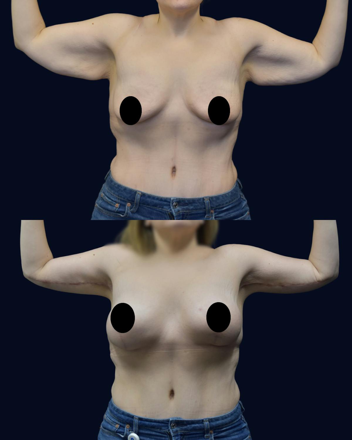 Breast Lift Before & After Gallery - Patient 310954 - Image 3