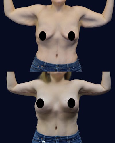 Brachioplasty (Arm Lift) Before & After Gallery - Patient 193626 - Image 1