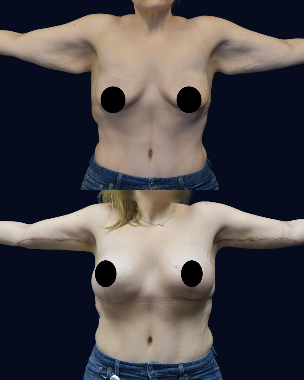 Breast Lift Before & After Gallery - Patient 310954 - Image 4
