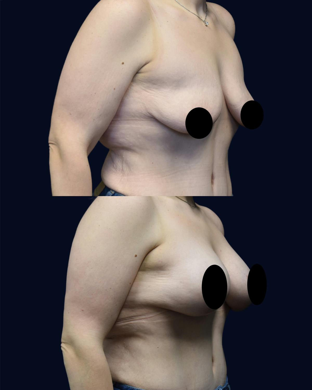 Breast Lift Before & After Gallery - Patient 310954 - Image 2