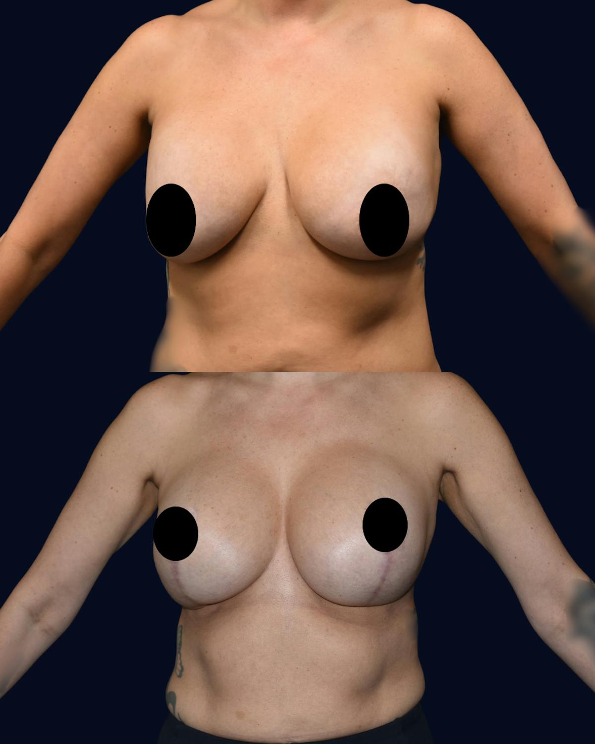 Breast Reduction and Lift with Implants Before & After Gallery - Patient 222102 - Image 1