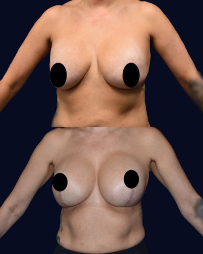 Breast Reduction and Lift with Implants Before & After Gallery - Patient 222102 - Image 1