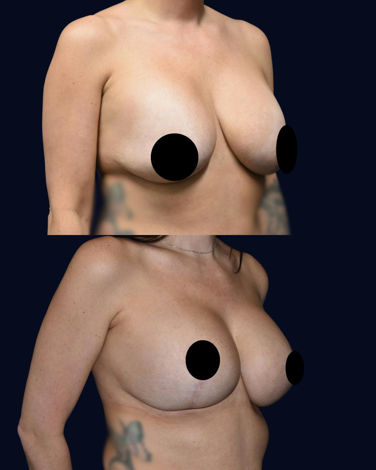 Breast Reduction and Lift with Implants Before & After Gallery - Patient 222102 - Image 2