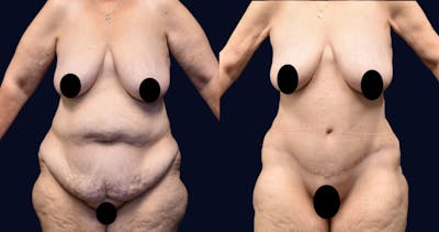 Abdominoplasty with Liposuction Before & After Gallery - Patient 263935 - Image 1