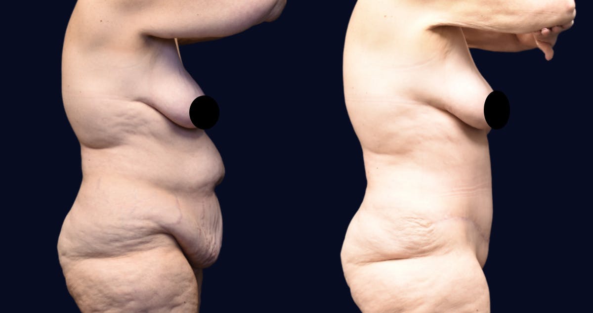 Abdominoplasty with Liposuction Before & After Gallery - Patient 263935 - Image 2