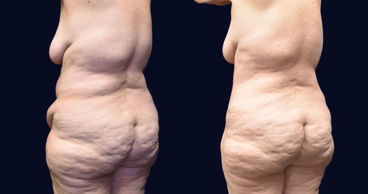 Abdominoplasty with Liposuction Before & After Gallery - Patient 263935 - Image 3