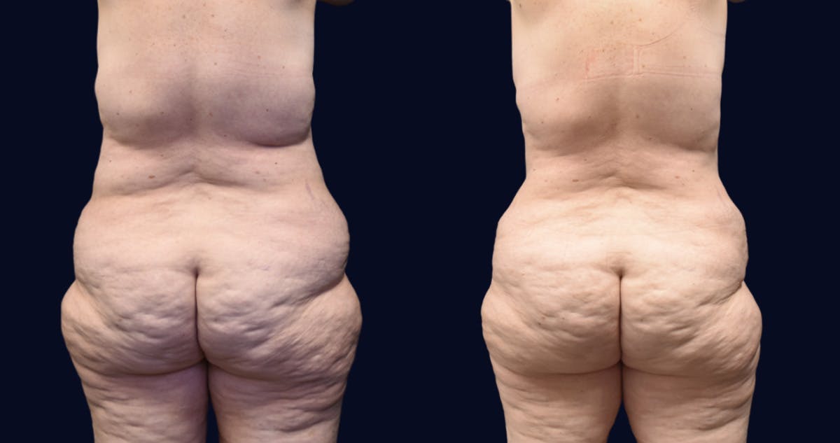 Abdominoplasty with Liposuction Before & After Gallery - Patient 263935 - Image 4
