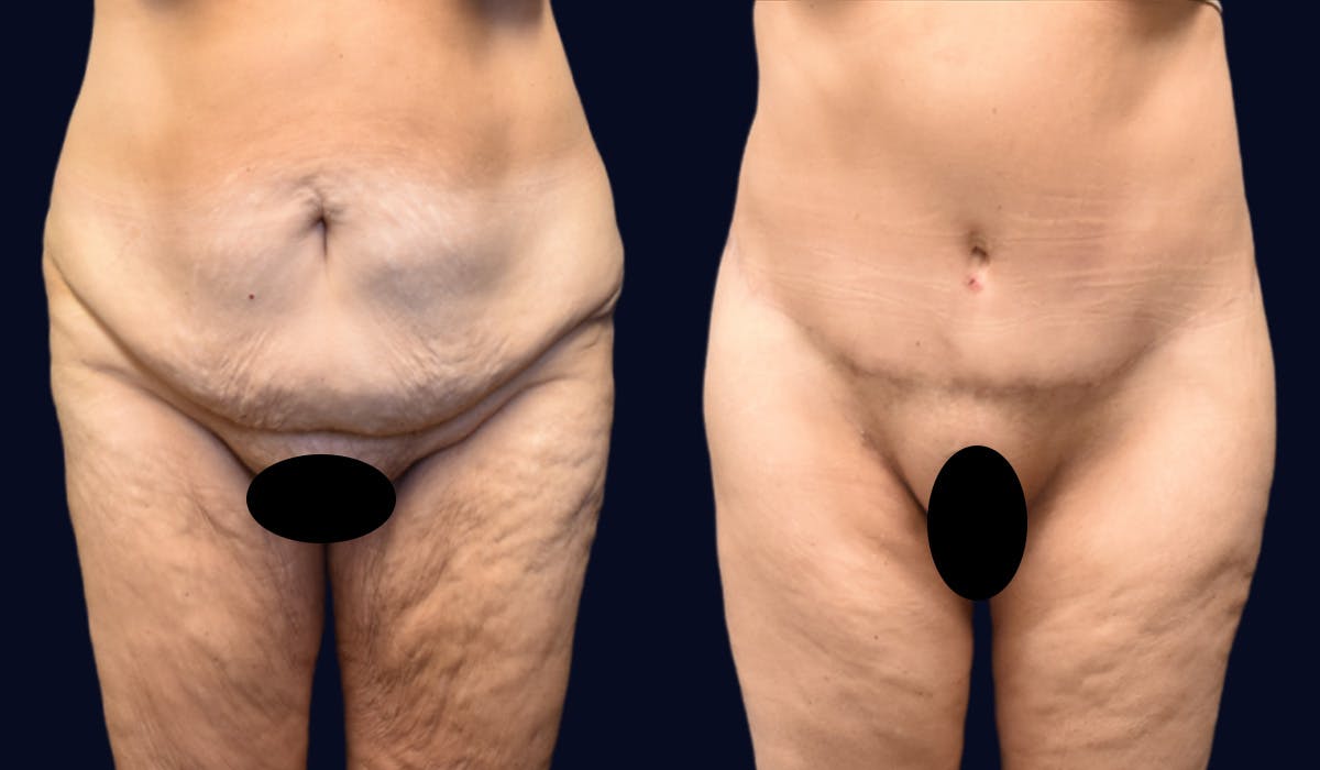 Thigh Lift with Liposuction Before & After Gallery - Patient 217175 - Image 1