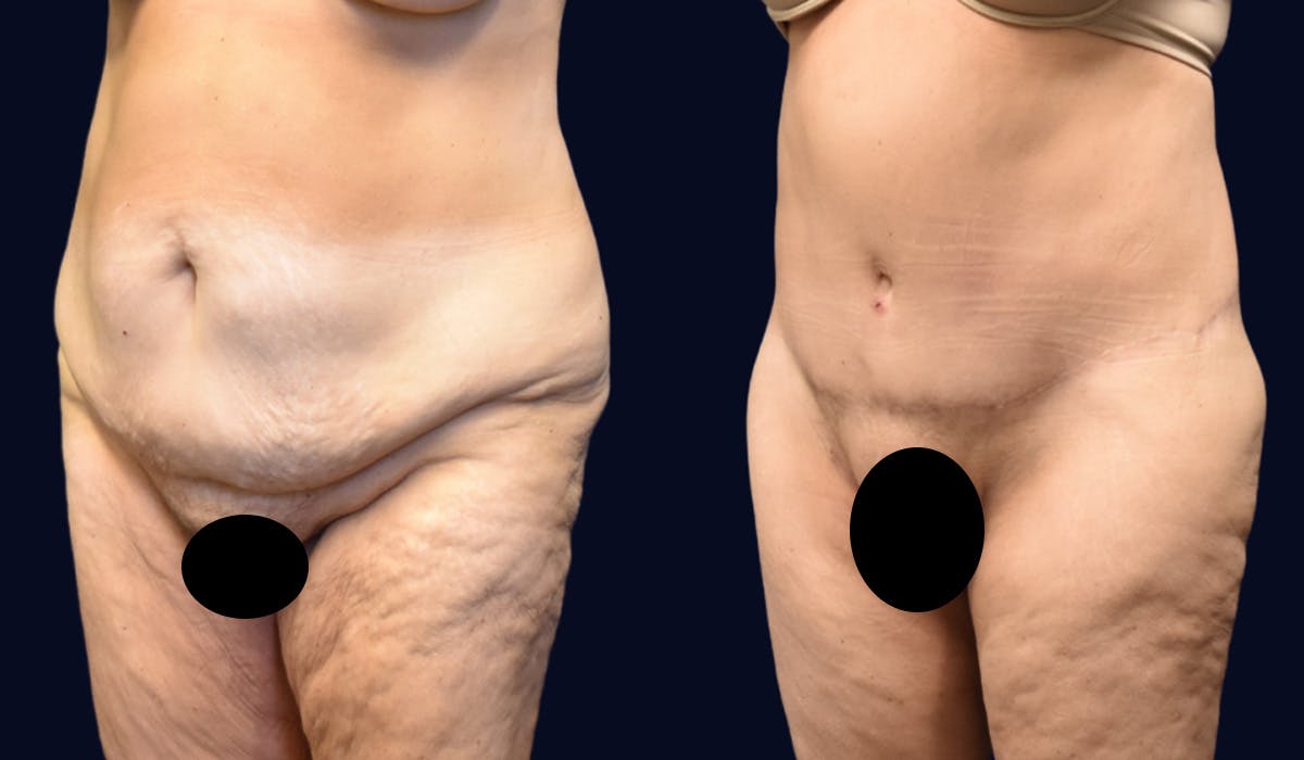 Thigh Lift with Liposuction Before & After Gallery - Patient 217175 - Image 2