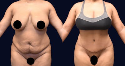 Abdominoplasty (Tummy Tuck) Before & After Gallery - Patient 288552 - Image 1