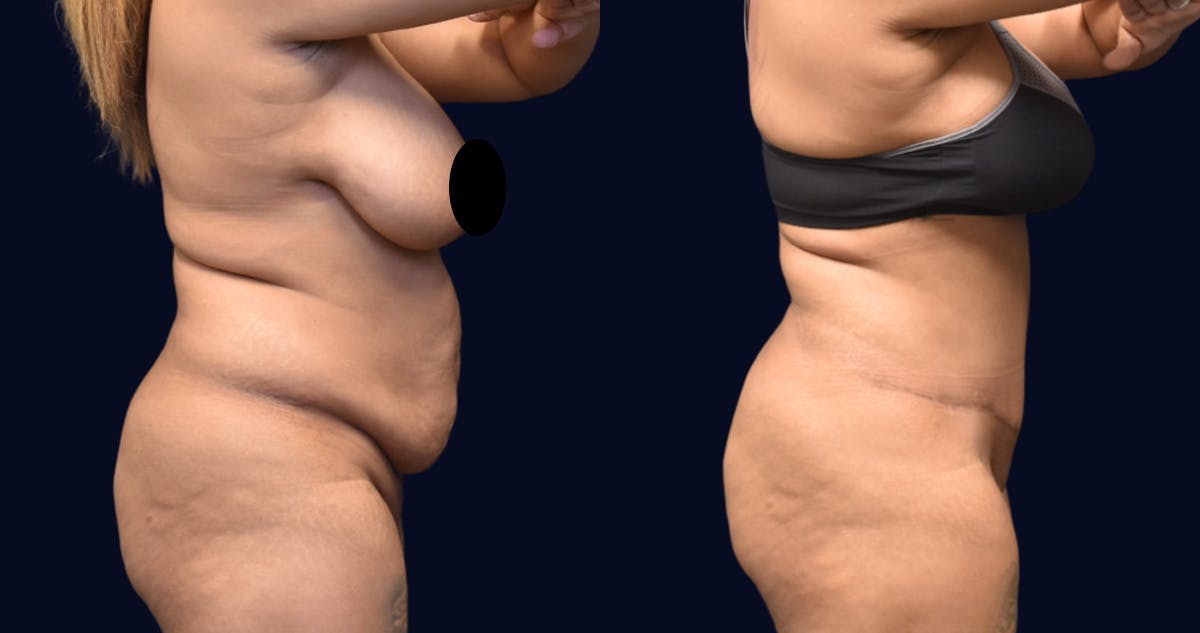 Abdominoplasty (Tummy Tuck) Before & After Gallery - Patient 288552 - Image 3