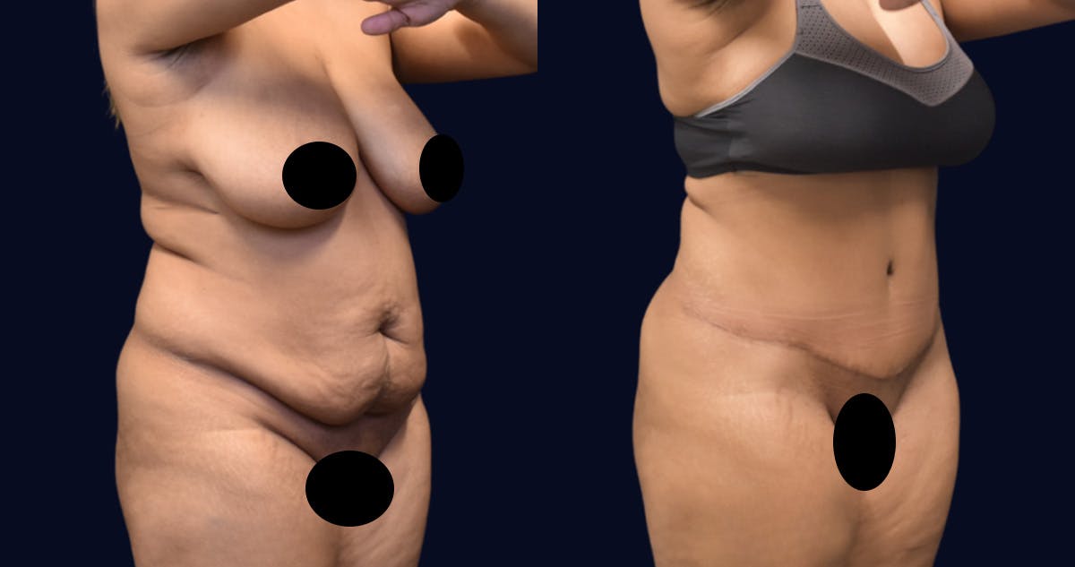 Abdominoplasty (Tummy Tuck) Before & After Gallery - Patient 288552 - Image 2